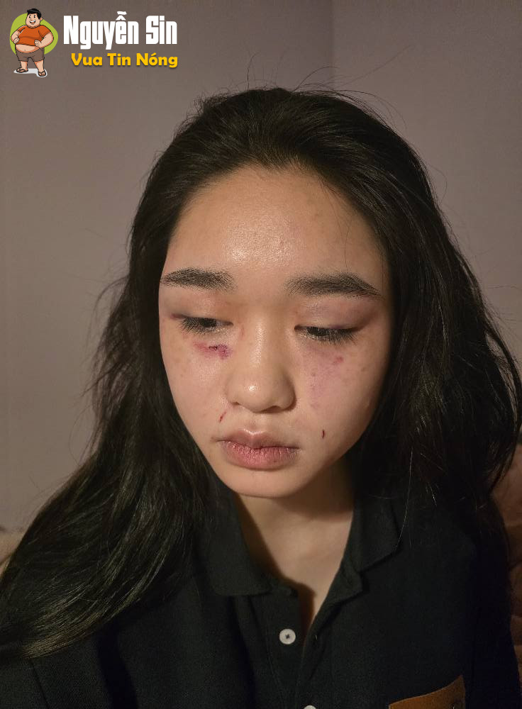 Hưng Yên: Một nữ sinh bị nhóm bạn hành hung lần thứ 3, gia đình cầu cứu cộng đồng mạng