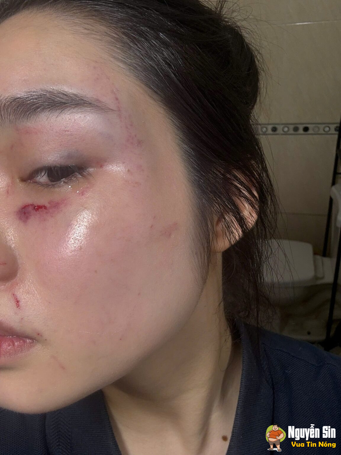 Hưng Yên: Một nữ sinh bị nhóm bạn hành hung lần thứ 3, gia đình cầu cứu cộng đồng mạng