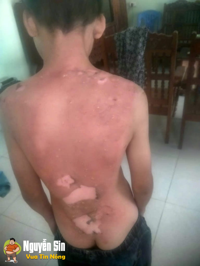 Lập Thạch – Vĩnh Phúc: dì ghẻ, con chồng, nước sôi, 12 tuổi
