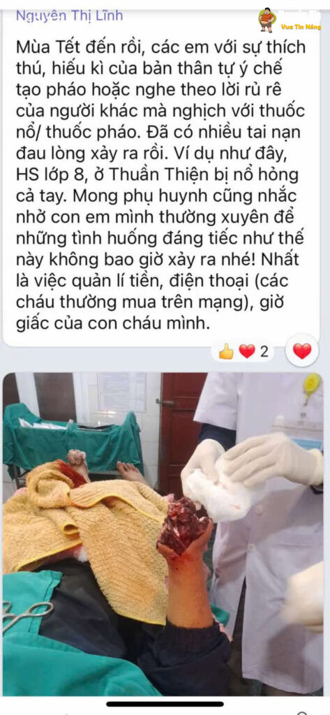 Liên tiếp những vụ hs chế ph@o, dập nat bàn tay. Mọi người chú ý nhắc nhở con em mình