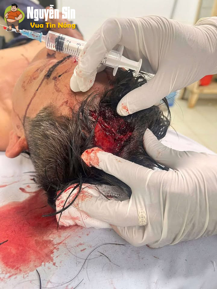 Bình Phước: 1 ng đàn ông bị đ@nh hội đồng khi nhắc nhở nhóm công nhân ăn nhậu hát karaoke