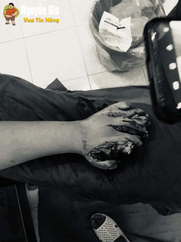 Nguy hiểm khi vừa sạc điện thoại vừa xem, cháu bé người Điện Biên tay h::ỏ::ng hết
