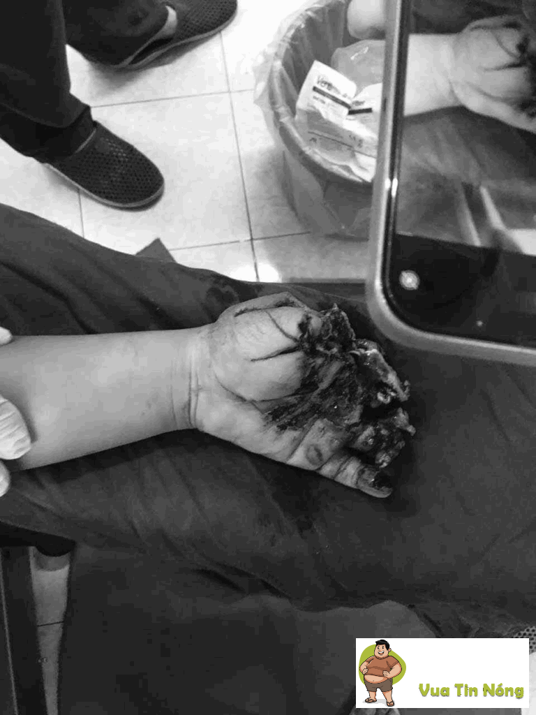 Nguy hiểm khi vừa sạc điện thoại vừa xem, cháu bé người Điện Biên tay h::ỏ::ng hết