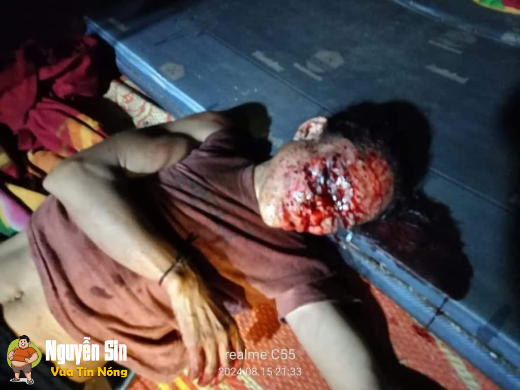 Bắc Mê – Hà Giang: Ck bă*n vợ khiến vợ phải đi cấp cứu. Không hiểu ngoài kia Vợ chồng thương nhau kiểu gì nữa