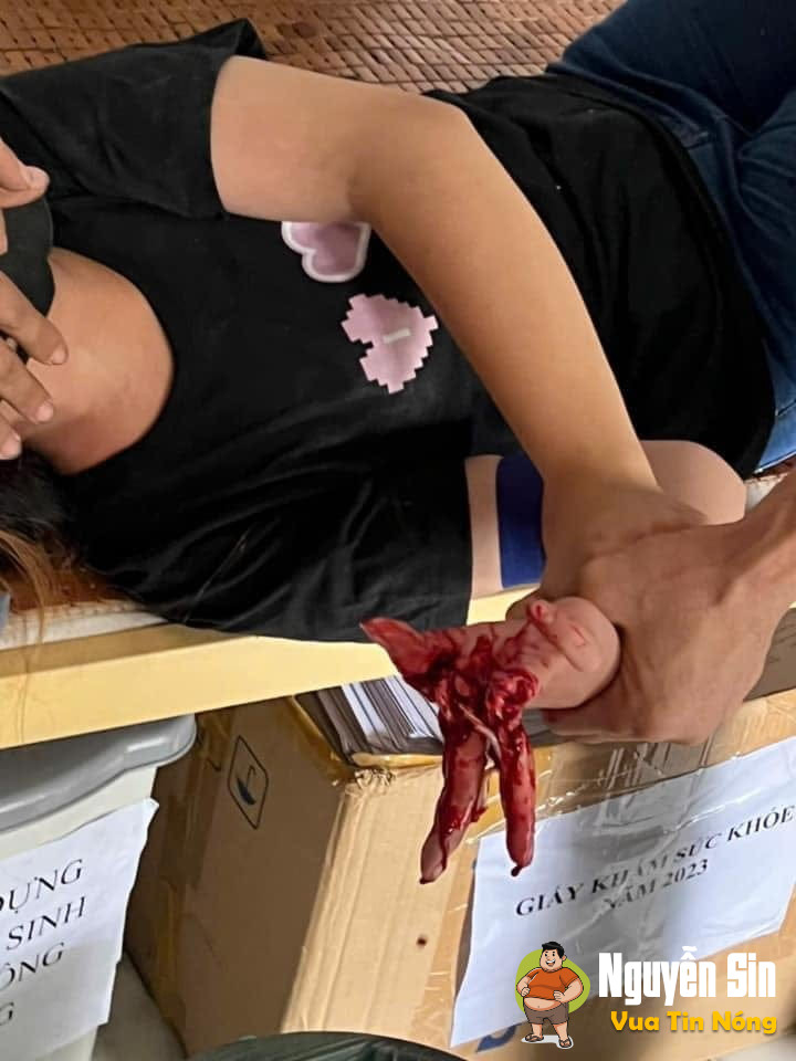 Biên Hoà – Đồng Nai : TNLĐ một công nhân bị cắt đứt các ngón tay phải