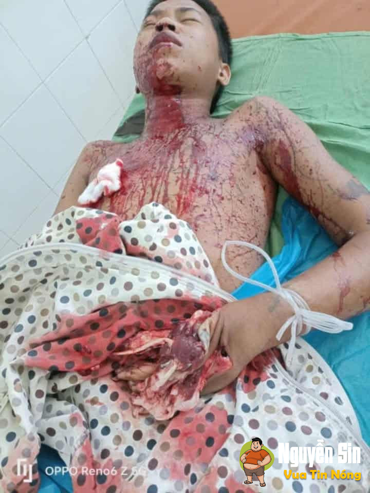 Đồng Tâm – Chợ Mới, Bắc Kạn: Nam Sinh bị dập na/t bàn tay vì sử dụng pháo tự chế