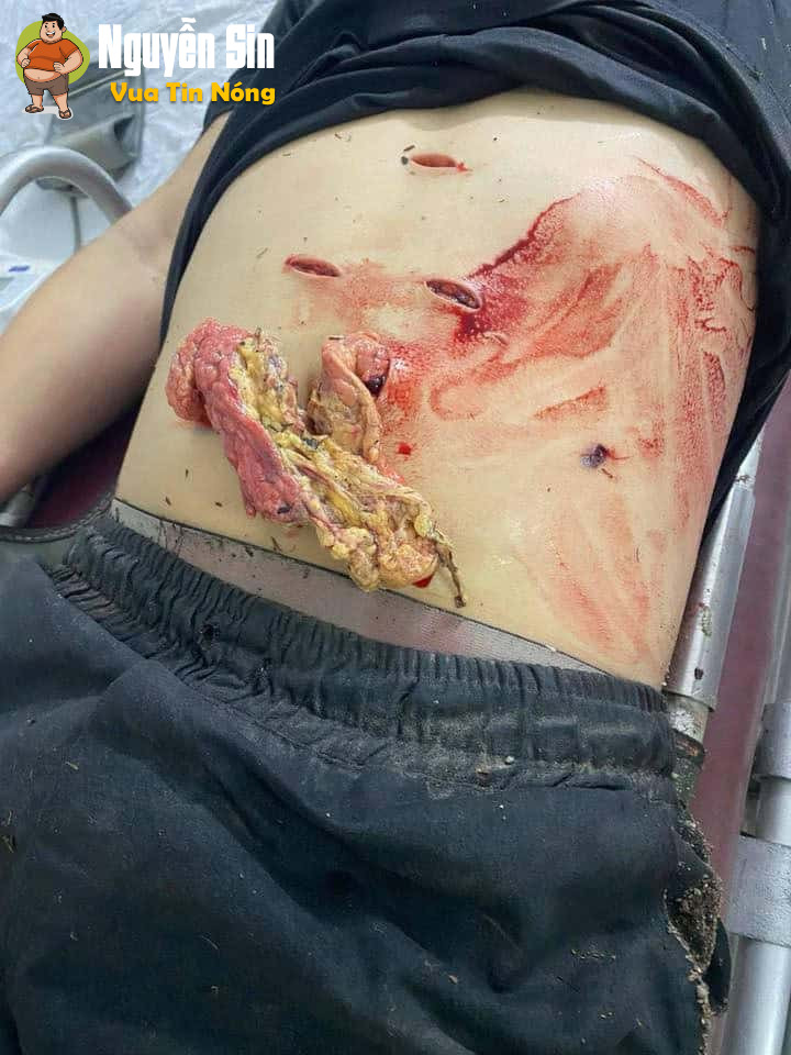 Thanh niên người Lục Nam, Bắc Giang nghi bị đ@m l::òi r::uột. Cân nhắc trước khi xem