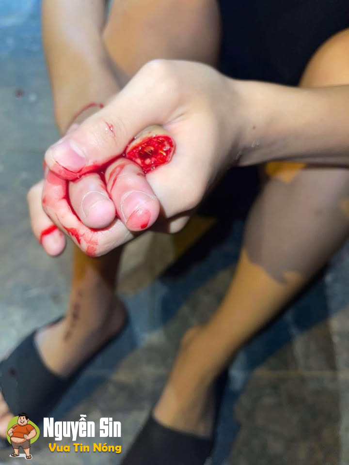 Bắc Kạn : Giải quyết mâu thuẫn bằng hu/ng khí, một thanh niên bị … đ/ứt lì/a đốt ngón tay
