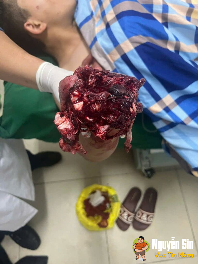Đồng Văn Hà Giang: mất 1 tay vì phao