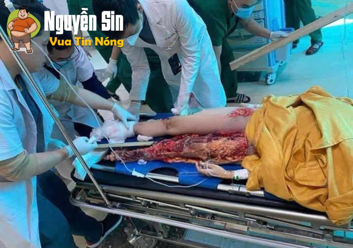 Ỷ La – Tuyên Quang: TNGT khiến 1 bạn nữ chân không còn nguyên vẹn…