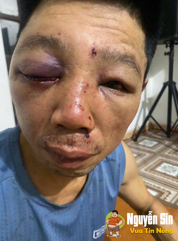 Ba Trại,Ba Vì,chưa rõ nguyên nhân vk đấm ck mất face id
