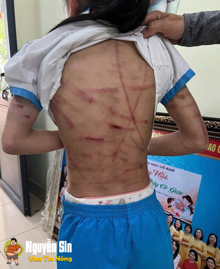 Bé gái lớp 5 ở Hà Tĩnh nghi bị baohanh, cơ thể ch.ằng ch.ịt vết thương Bé gái lớp 5 ở Hà Tĩnh nghi bị baohanh, cơ thể ch.ằng ch.ịt vết thương