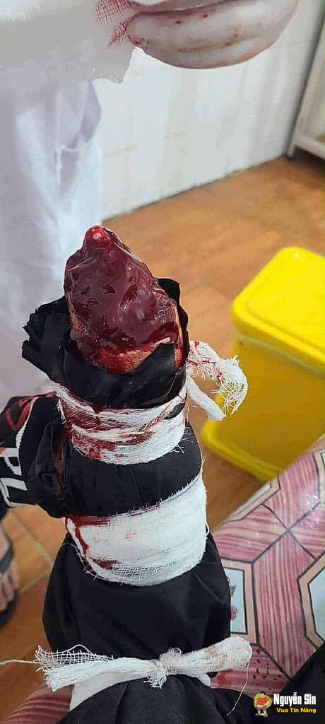 Nhóm thanh niên che’m nhau đứt lìa bàn tay Nhóm thanh niên che’m nhau đứt lìa bàn tay