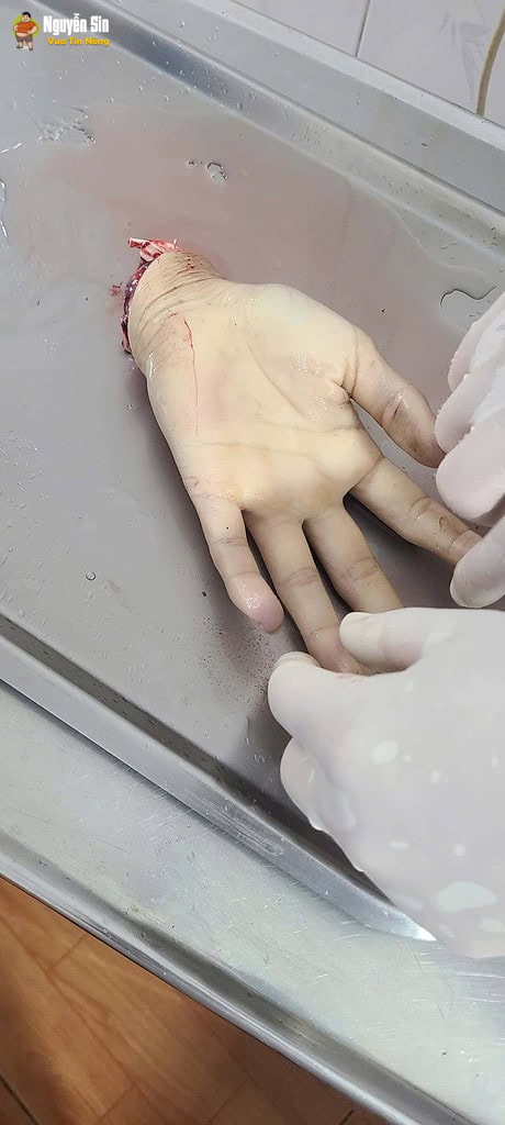 Nhóm thanh niên che’m nhau đứt lìa bàn tay Nhóm thanh niên che’m nhau đứt lìa bàn tay