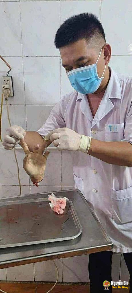 Nhóm thanh niên che’m nhau đứt lìa bàn tay Nhóm thanh niên che’m nhau đứt lìa bàn tay