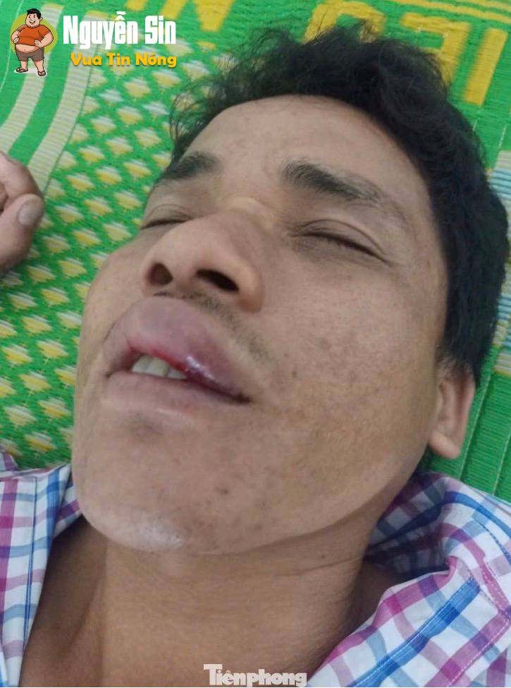 Đắk Lắk: Người đàn ông từ chối cuộc nhậu Bị đ@’nh đến “thân tàn ma dại” nhưng lại bị kết luận thương tích 0%