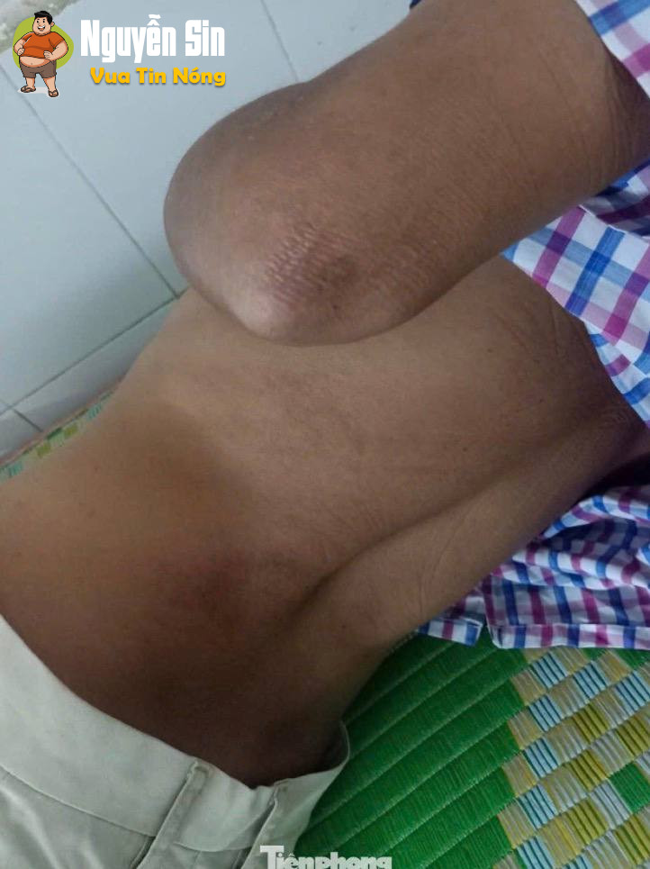 Đắk Lắk: Người đàn ông từ chối cuộc nhậu Bị đ@’nh đến “thân tàn ma dại” nhưng lại bị kết luận thương tích 0%